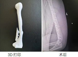 延安市中医医院借力3D打印技术 助推骨科创伤水平向“高、精、尖”发展