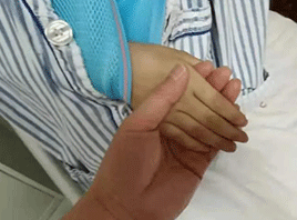 西安市第三医院骨科成功完成院级首例儿童骨肉瘤3D打印肩关节置换手术