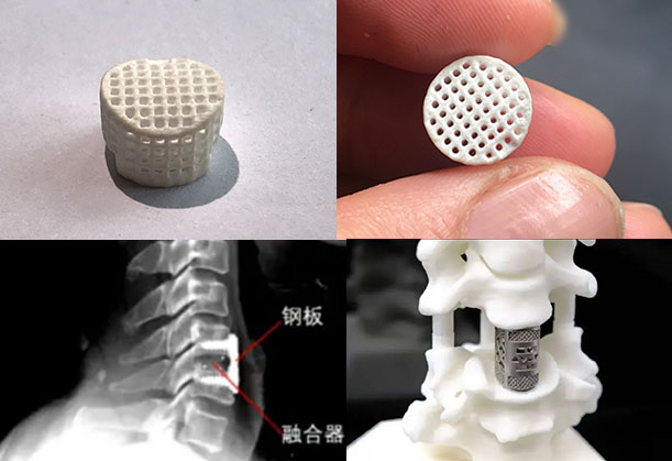 脊椎椎间融合器用于动物或人体骨缺损修复